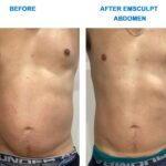 Emsculpt-Abdomen-01