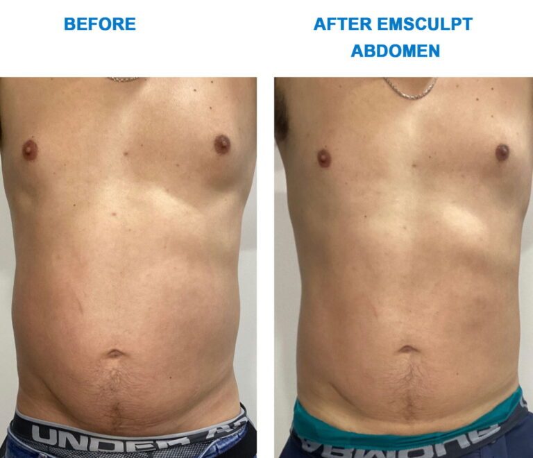 Emsculpt-Abdomen-01