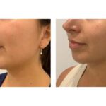 Exilis Ultra
