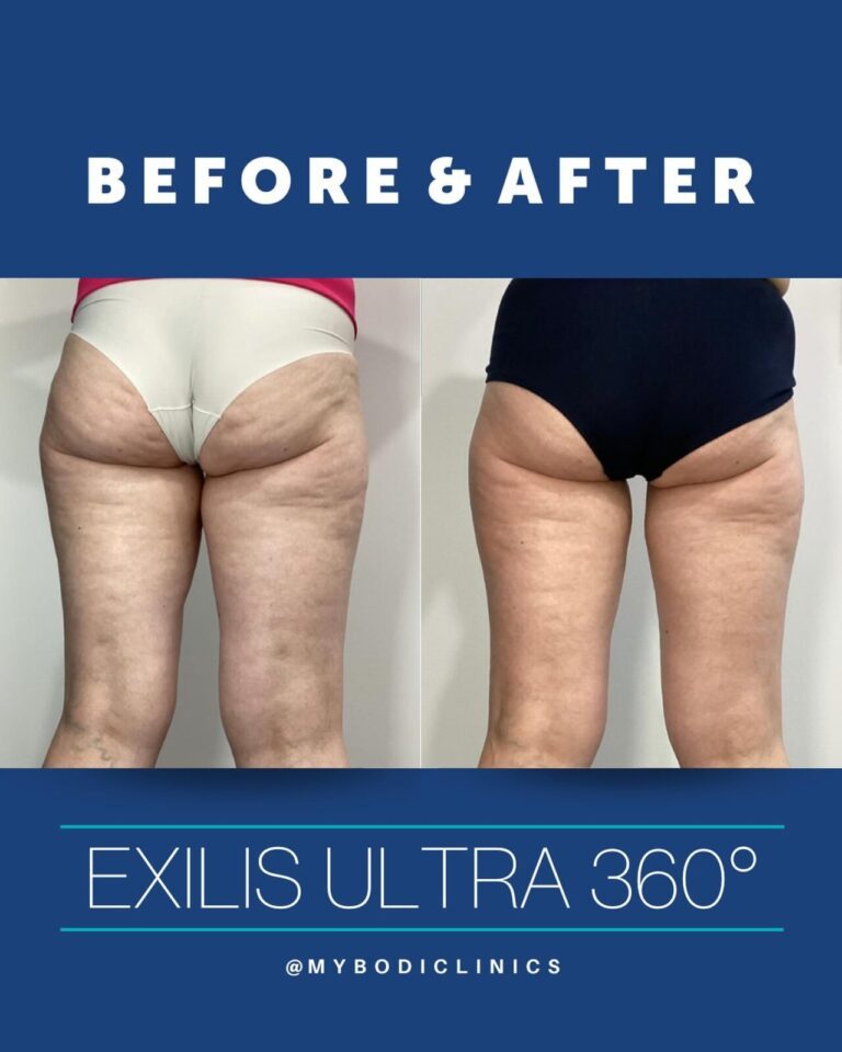 Exilis Ultra 360