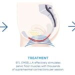 emsella treatment