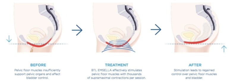 Mybodi Clinics emsella treatment