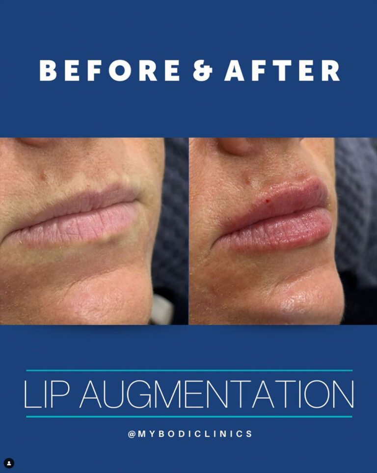 Mybodi Clinics lip_augmentation