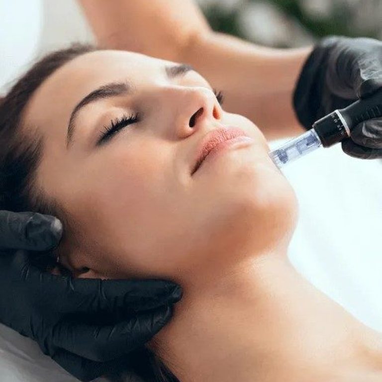 RF Microneedling